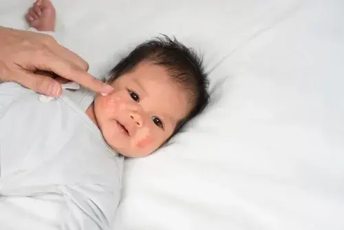 Risiko Komplikasi Berat: Bahaya Penyakit Campak Bagi Bayi di Bawah Satu Tahun
