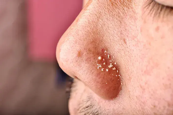 Basmi Komedo Putih di Hidung Sebelum Jadi Jerawat Parah: Simak Cara Mengatasinya