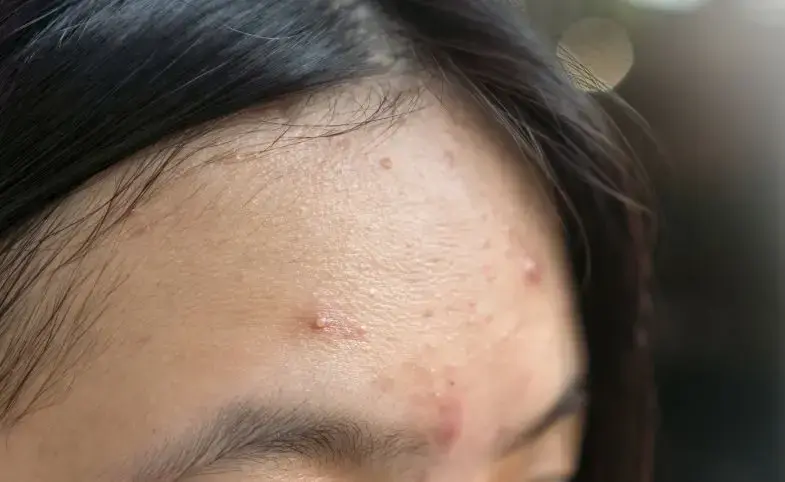 Jerawat di Dahi Tak Kunjung Sembuh? Kenali Pemicu Tersembunyi dan Cara Mengatasinya