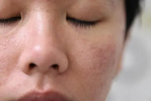 Tips Merawat Skin Barrier: Cara Mengatasi Kulit yang Sedang Mengalami Iritasi