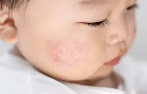 Anak Sering Gatal dan Kulit Kemerahan? Waspada Gejala Dermatitis Atopik atau Eksim