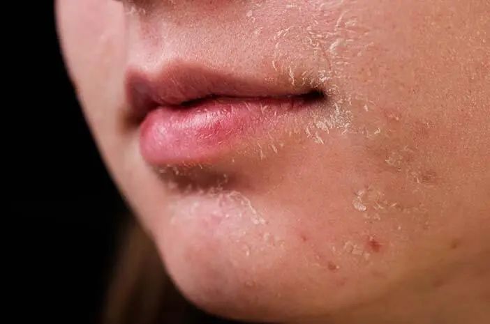 Penyebab Kulit Kering dan Mengelupas: Simak Cara Mengatasinya Agar Tetap Glow Up
