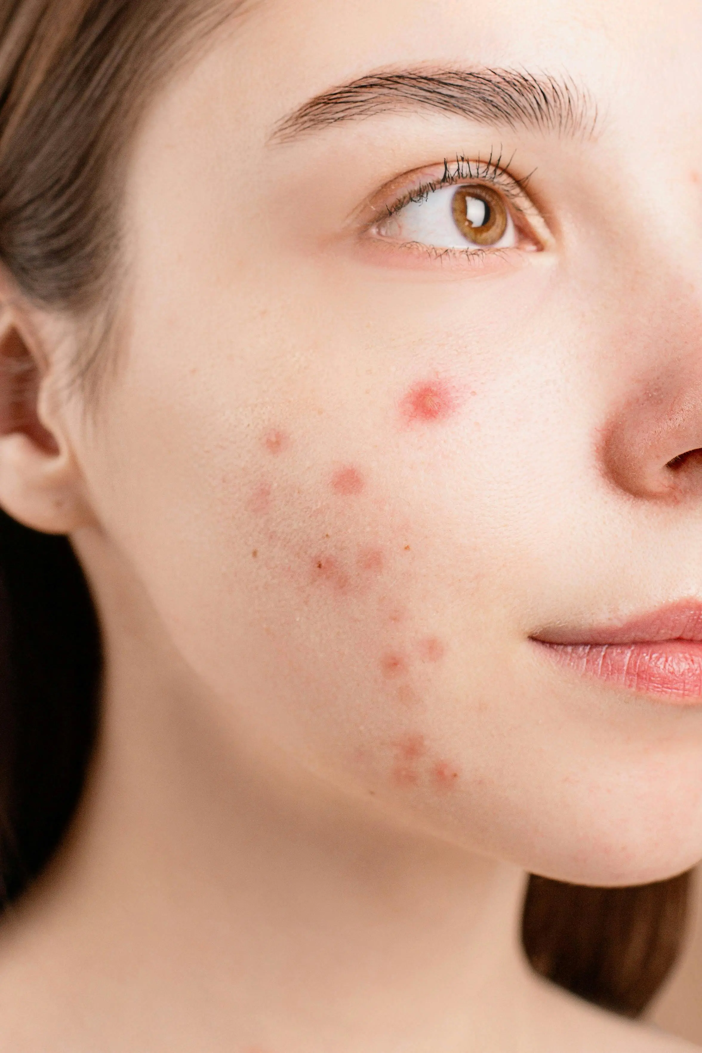 Sering Jerawatan? Cek Hubungan Diet dan Kesehatan Kulit Menurut Ahli Dermatologi